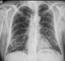 Chest X-ray: Nodular shadows both lungs