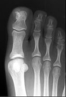 X-ray foot showing subungal exostosis