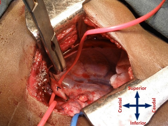 File:Thoracotomy wih subclavian artery.jpg