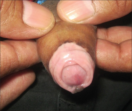 File:Lichen sclerosus penile (depigmented).png