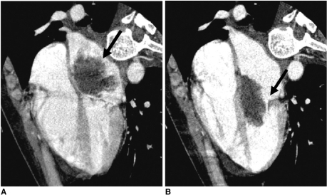 File:CT left atrial myxoma.png