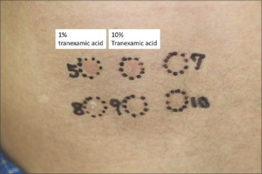 File:Tranexamic acid-induced FDE patch test.png