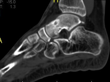 File:Osteoid-osteoma-of-the-talus-1.jpg