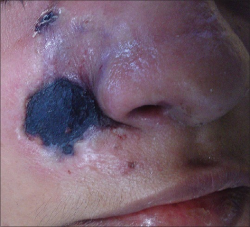 File:Rhinocerebral mucormycosis.png