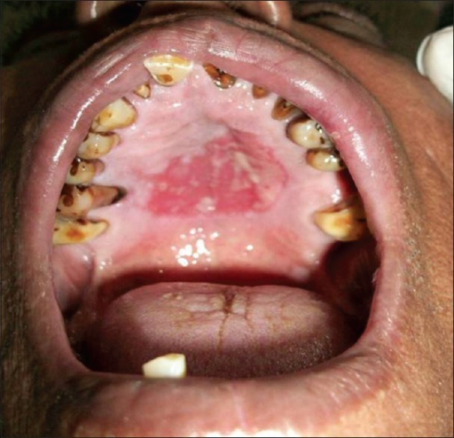 File:Fixed drug reaction hard palate.png