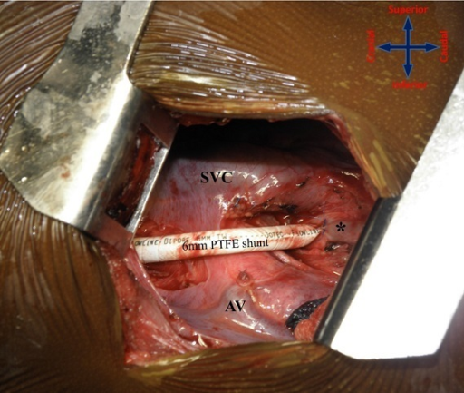 File:Thoracotomy - Blalock-Taussig shunt.png