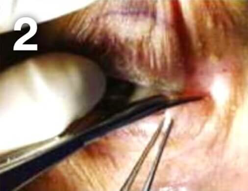 File:Lateral+Canthotomy+procedure+(Step+2).jpg