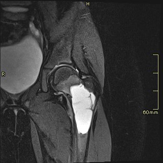 File:Unicameral-bone-cyst-left-proximal-femur-1.jpg