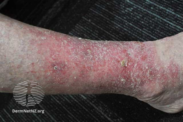 File:Venous-eczema-001.jpg