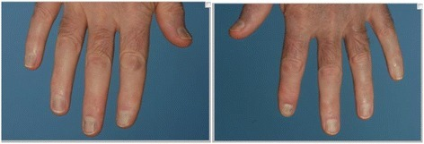 File:Blue nails from retigabine.png