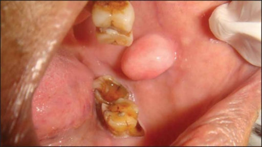 File:Angiofibroma inside cheek.png