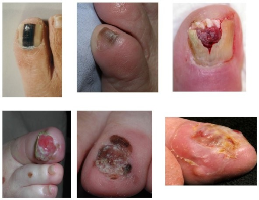 File:Melanoma nails 1.png