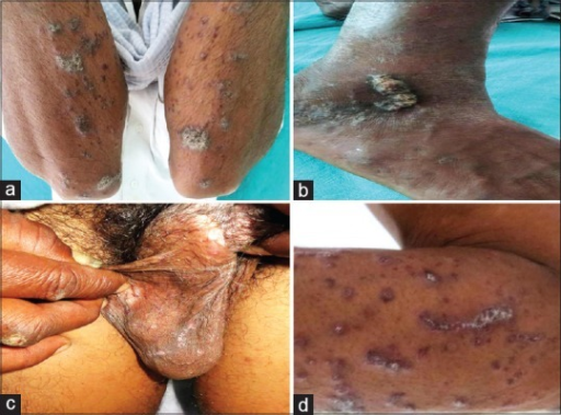 File:Nekam's disease 1.png