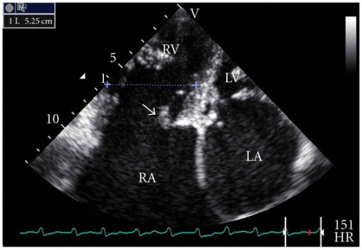 File:Transthoracic echo - TR.png