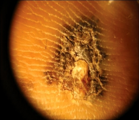 File:Acral lentiginous melanoma ridges.png