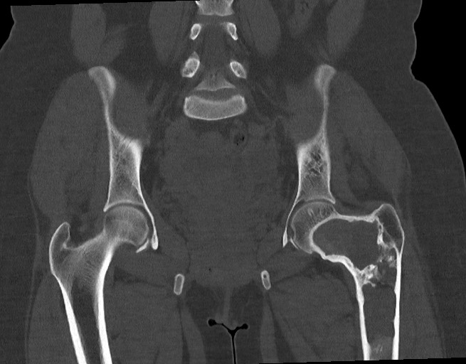 File:Fibrous-dysplasia-femur-and-pelvis.jpg