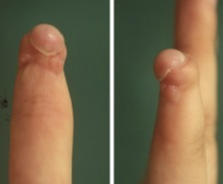 File:Hook nail deformity.png