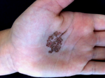 Tinea nigra speckled palm.png