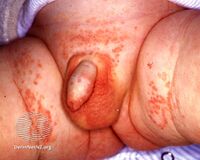 Diaper rash in a male[7]