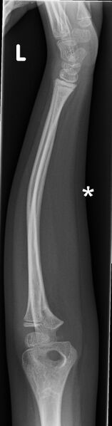 File:Bowing fracture radius and ulna side view.jpg