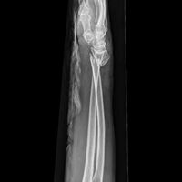 Side view of displaced fractured radius and ulna at wrist