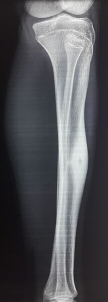 File:Osteoid-osteoma-of-tibia-lateral view.jpg