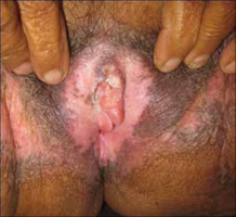 Lichen sclerosus: scarring and squamous cell carcinoma clitoris