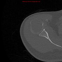 1.b. CT scan: solitary plasmacytoma upper arm near shoulder