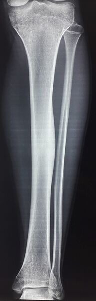 File:Osteoid-osteoma-of-tibia-front view.jpg