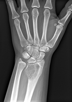 Front view X-ray. A well-defined expansile lesion in radius near wrist