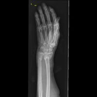 Front view of displaced fractured radius and ulna at wrist