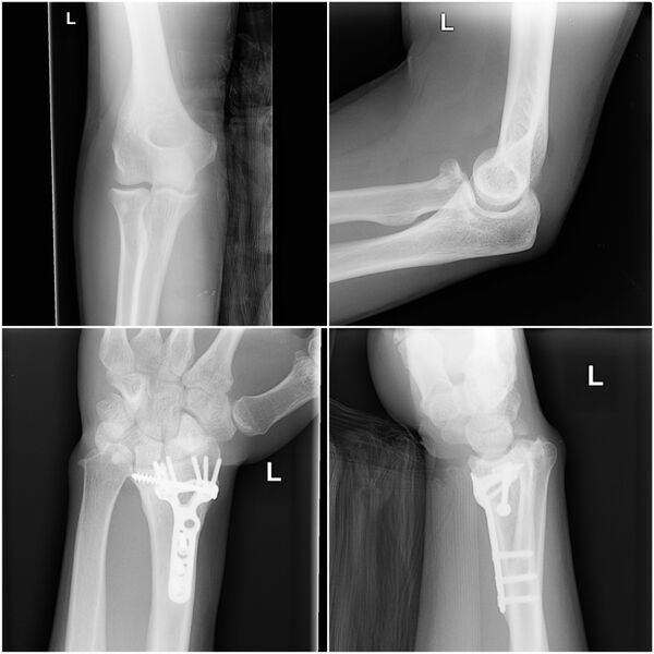 File:Essex-lopresti-fracture-dislocation.jpg