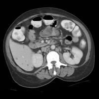 CT scan: Liver candidiasis - multiple small rounded foci in liver and spleen.