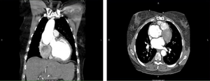 CT of the chest. Coronal (left) and axial (right) views demonstrating pathologic dilatation of the aortic root and ascending aorta. On the axial image, a dissection plane is noted in the aortic root.