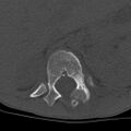 CT scan axial view: expansile osteoblastoma spine