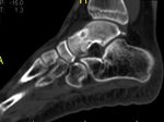 Osteoid-osteoma-of-the-talus-1.jpg
