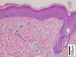 Keratosis lichenoides chronica hist2.png