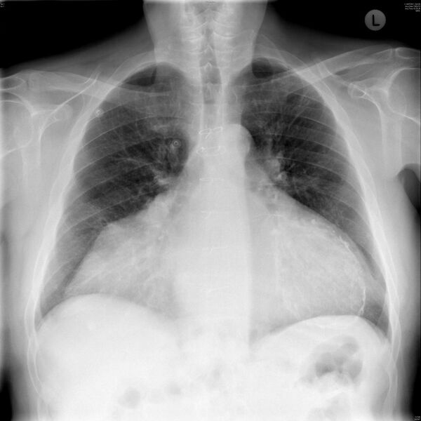 File:Chest X-ray. Heterotopic heart transplantation.jpg