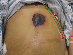 Mucormycosis skin: after liver transplantation