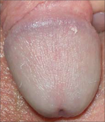 Single pearly penile papule on glans