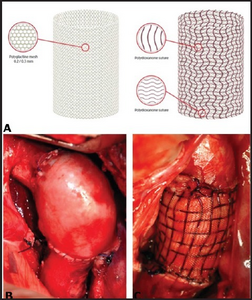 Pulmonary autograft with no reinforcement and reinforced with bioresorbable prosthesis