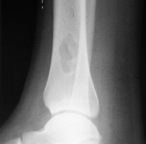 1. b. Side view X-ray: NOF of the lower leg bone near ankle, with well-defined tumor