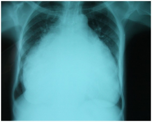 Chest-Xray: enlarged heart in TR and mitral valve disease