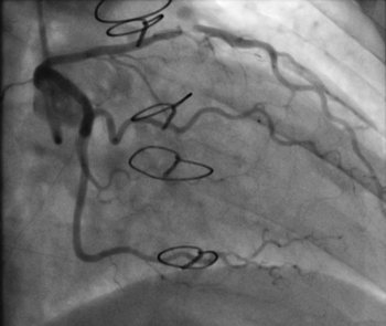 Partial occlusion of the left anterior descending artery on routine follow-up 8 months after transplantation.