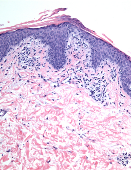 File:Keratosis lichenoides chronica histology.png