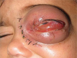 Swelling of upper and lower eyelid