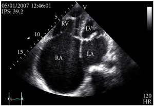 Transthoracic echo: enlargement of the right atrium in TR and mitral valve disease