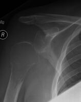 1.a. X-ray: solitary plasmacytoma upper arm near shoulder