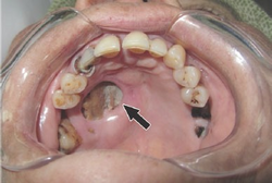 Tissue destruction of inside upper mouth