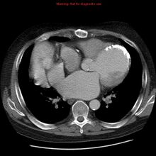 CT chest: demonstrates the left anatomic connections in a heterotopic transplant